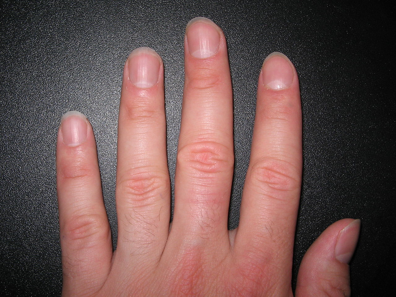 my-fingernails-split-down-the-middle-why-is-that